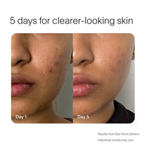 Load image into Gallery viewer, Bye Acne Pro Kit
