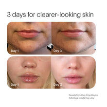 Load image into Gallery viewer, Bye Acne Pro Kit
