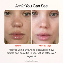 Load image into Gallery viewer, Bye Acne: 3-Minute Pimple Spot Treatment
