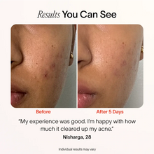 Load image into Gallery viewer, Bye Acne: 3-Minute Pimple Spot Treatment
